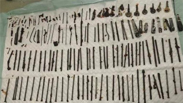 NGILU! Dokter Temukan 120 Benda Asing di Perut Pasien, Ada Pisau-Gunting: Kok Bisa?