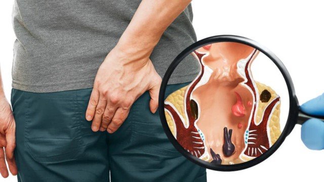 Symptoms of Piles in Men: Causes and Treatment – Signs, Risks, and Relief Options