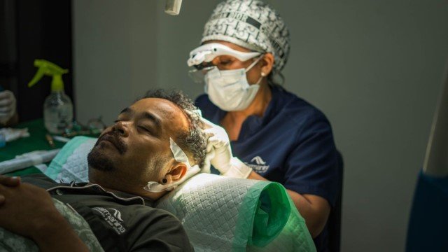 Transplantasi Rambut, Solusi Permanen Atasi Penipisan Rambut Dengan Tepat